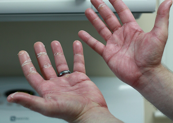 Capecitabine-Associated Hand-Foot Syndrome